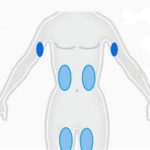 coolsculpting-miami-front