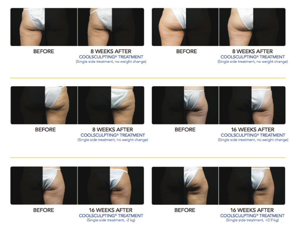 Coolsculpting-BA