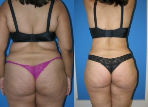 Brazilian butt lift Miami