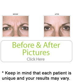 bf-botox2