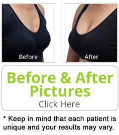 bf-implant3