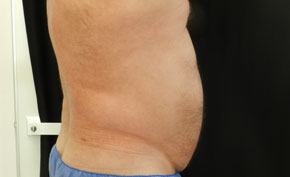 coolsculpting-1