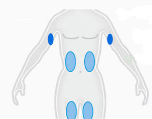 Liposuction in Miami