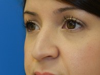 Miami nose job