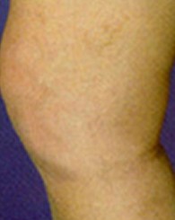 sclerotherapy_a1