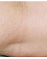 sclerotherapy_a3