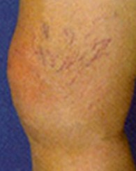 sclerotherapy_b1