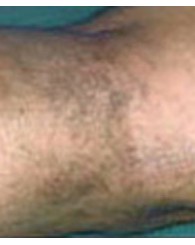 sclerotherapy_b3