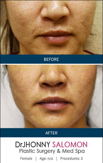 skinpen-1