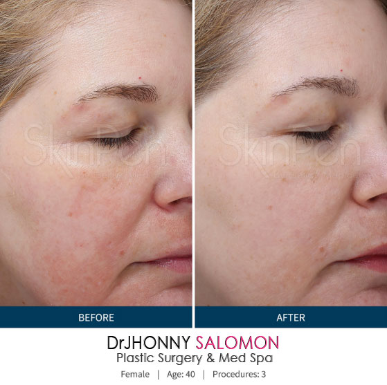 skinpen-2