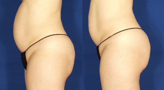 velashape-1