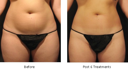 velashape-2