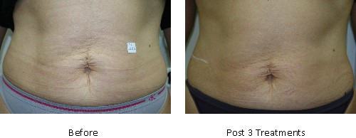velashape-3