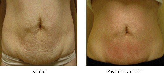 velashape-4
