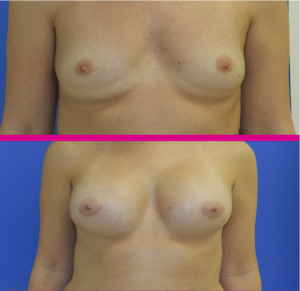 Breast Aug