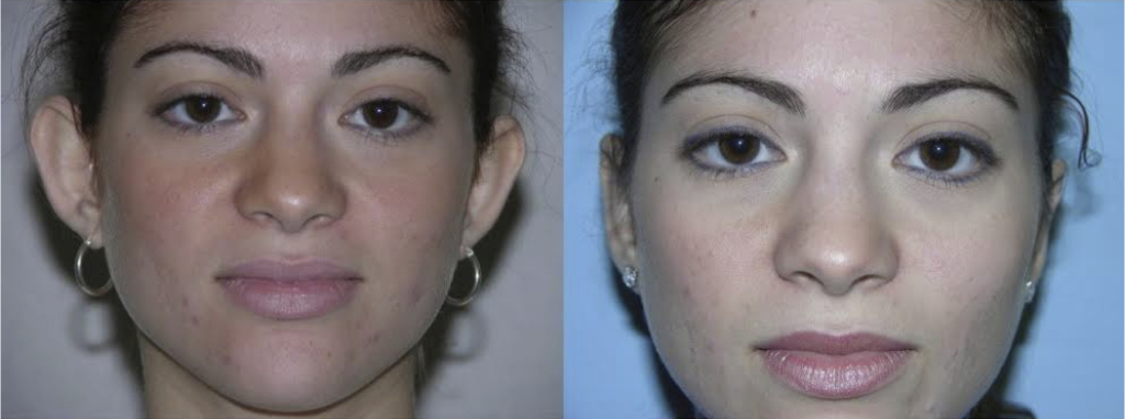 Otoplasty Front