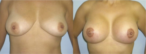 breast lift ba