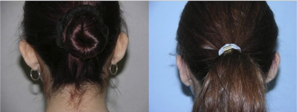 otoplasty back