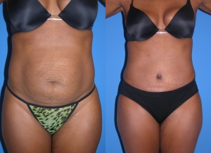 Belly Fat