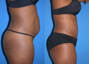 Belly Fat2