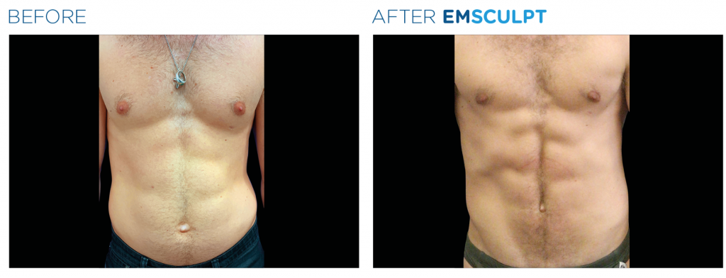 emsculpt miami