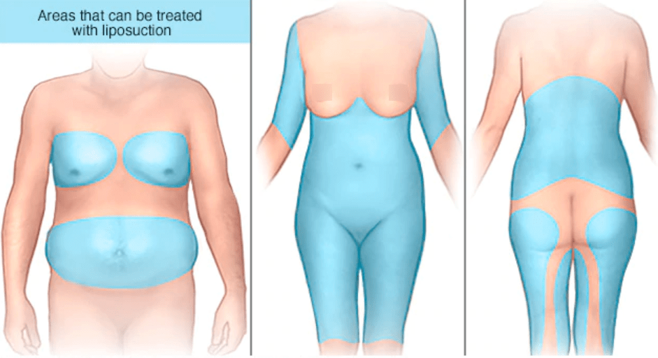 Dr.-Salomon-Areas-That-Can-Be-Treated-with-Liposuction