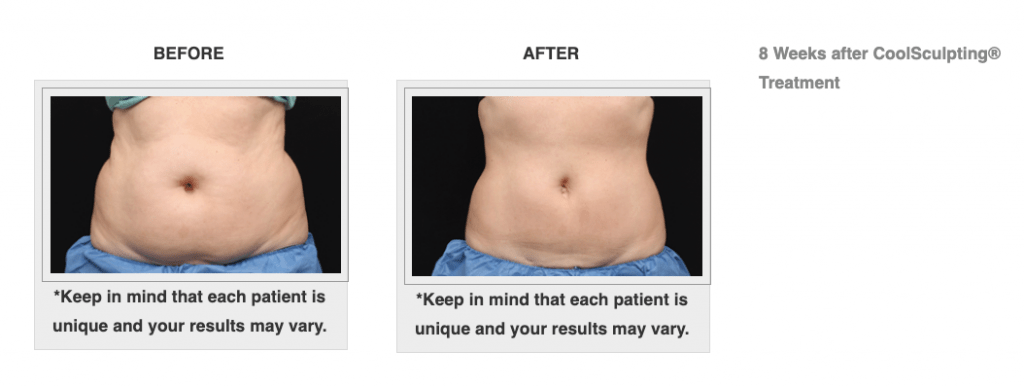 Dr.-Salomon-CoolSculpting-Before-and-After-1-1024x387