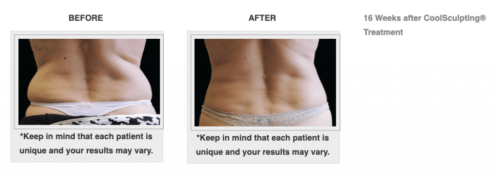 Dr.-Salomon-CoolSculpting-Before-and-After-2-1024x365