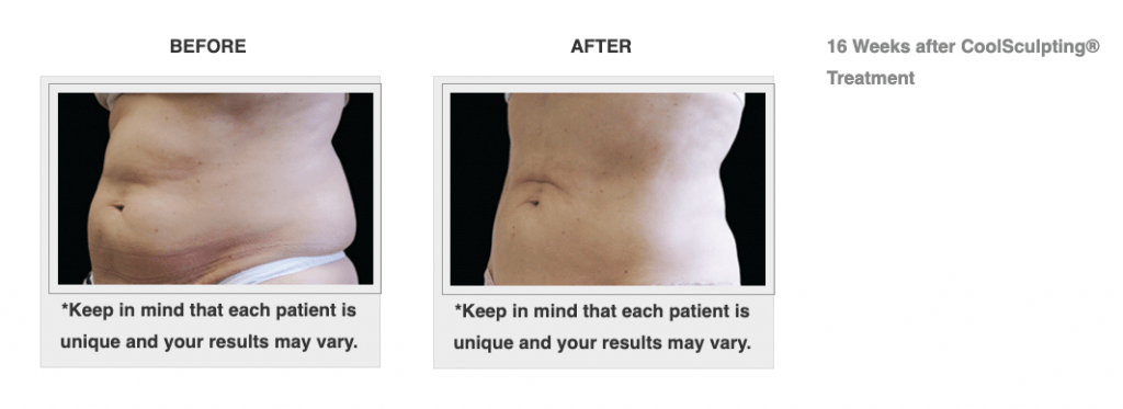 Dr.-Salomon-CoolSculpting-Before-and-After-3-1024x373