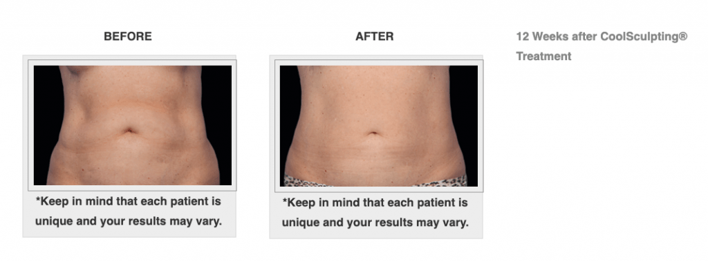 Dr.-Salomon-CoolSculpting-Before-and-After-4-1024x379