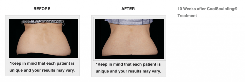 Dr.-Salomon-CoolSculpting-Before-and-After-5-1024x344