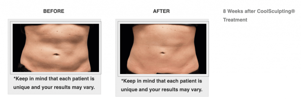 Dr.-Salomon-CoolSculpting-Before-and-After-6-1024x359