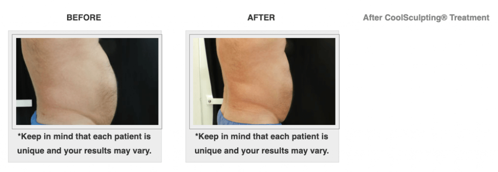Dr.-Salomon-CoolSculpting-Before-and-After-7-1024x354