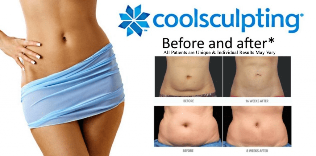 Dr.-Salomon-CoolSculpting-Before-and-After-Results-1024x508