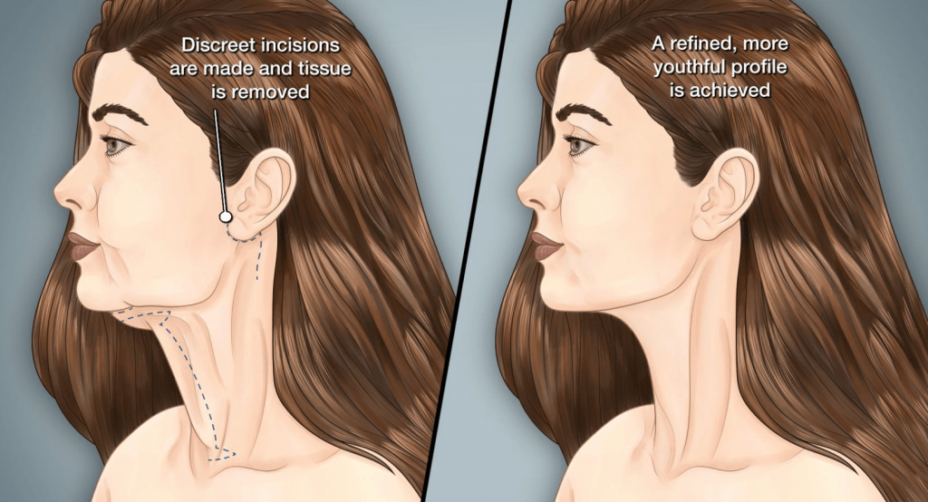 Dr.-Salomon-Neck-Lift-Image-1024x554