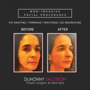 Dr-Salomon-Non-Ivasive-Facial-Procedures