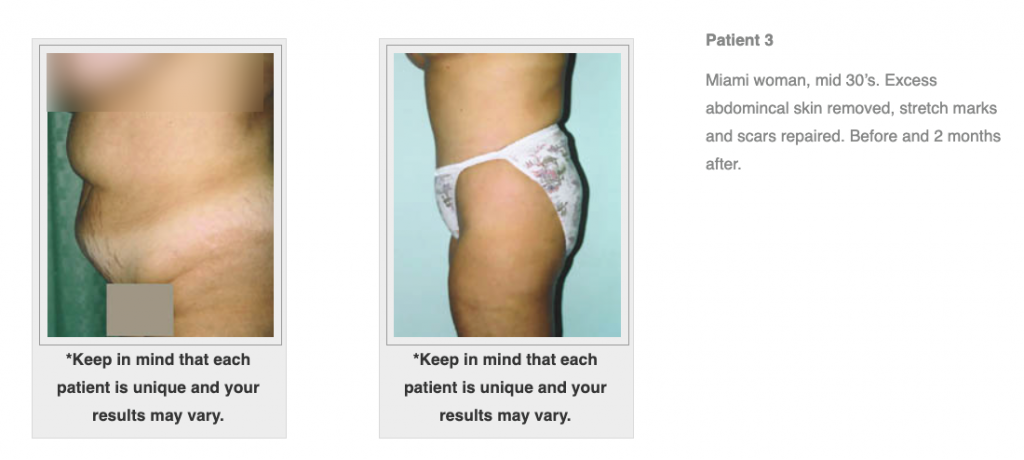 Dr Salomon Tummy Tuck