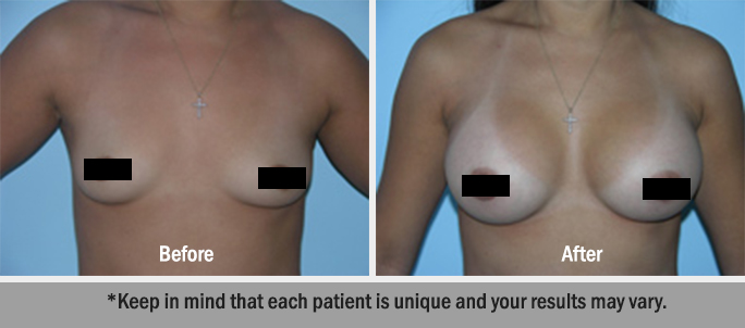 Breast Augmentation Dr. Salomon