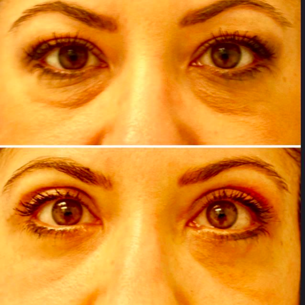 Dr Jhonny Salomon Blepharoplasty Before and After