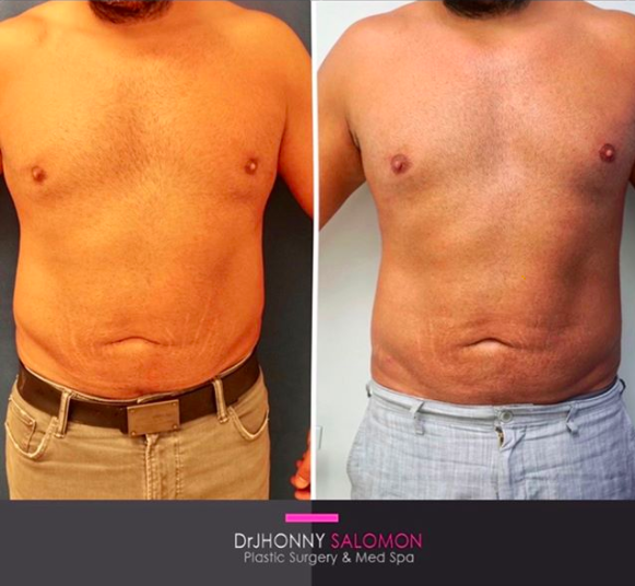Liposuction and Fat Grafting Dr. Jhonny Salomon