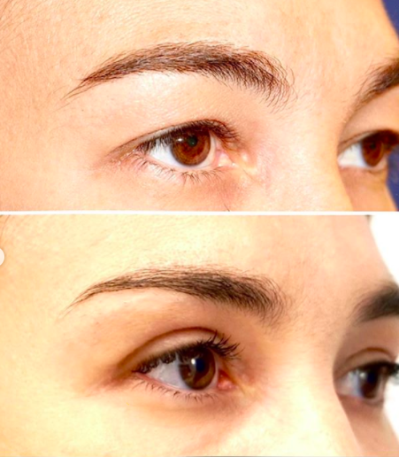 Blepharoplasty Dr Jhonny Salomon Miami