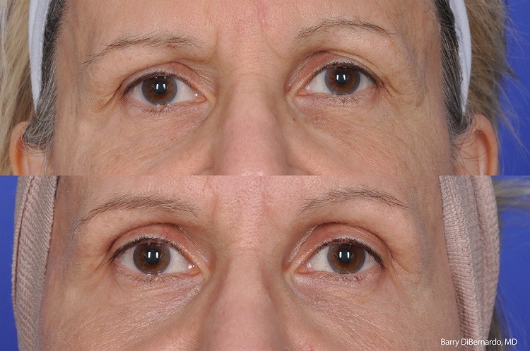 Barry DiBernardo_ThermiSmooth_Eyes