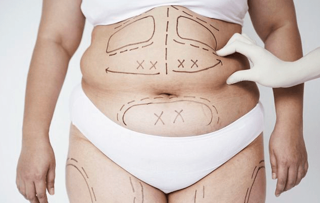 Dr-Salomon-Tummy-Tuck-Picture-1