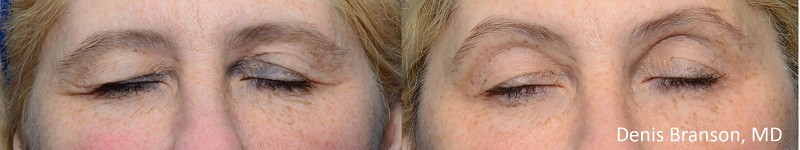 ThermiSmooth - DB eyes before and after