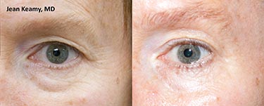 ThermiSmooth-JK-male-eyes-before-and-after_72dpi