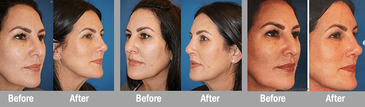 Miami Florida Plastic Surgery and Med Spa Revision Rhinoplasty Dr Jhonny Salomon