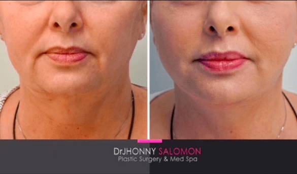 2 weeks before and after Dr. J Salomon Face and Neck Lift Miami Plastic Surgeon