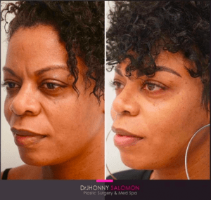 Ethnic Revision Rhinoplasty Before and After Dr. J Salomon Plastic Surgery and Med Spa Miami Florida