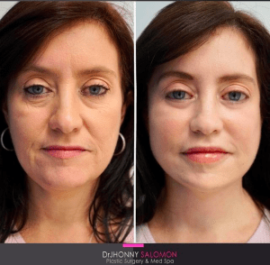 Facelift, Neck lift, fat grafting in Miami Florida Dr Jhonny Salomon