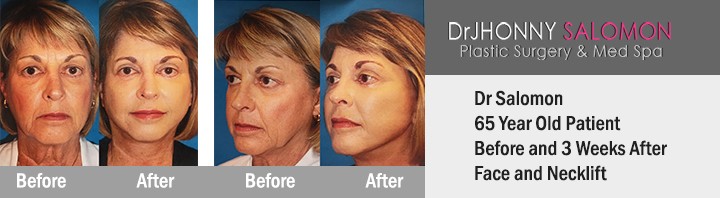 Dr. Jhonny Salomon face and neck lift miami